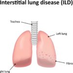 Interstitial Lung Disease & Your Workers’ Comp Claim