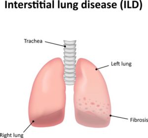 interstitial lung disease